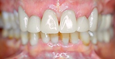 White and healthy smile after treatment