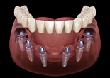 Animaiton of implant supported denture placement
